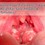 Remedies for Sore Throats & Tonsillitis