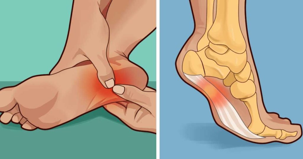 Treat and Prevent Plantar Fasciitis at Home