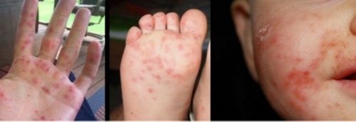 Hand-Foot-And-Mouth Disease On The Rise