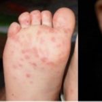 Hand-Foot-And-Mouth Disease