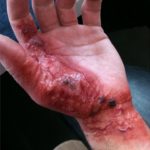 Burn Injuries On and Off The Grid